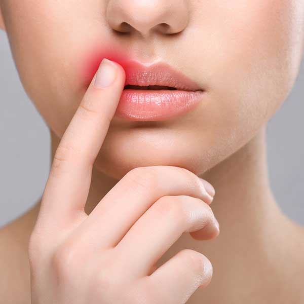 Dating Someone with Herpes – Should You or Not?